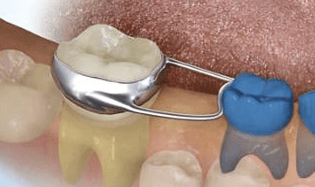 اهمیت حفظ دندان های شیری