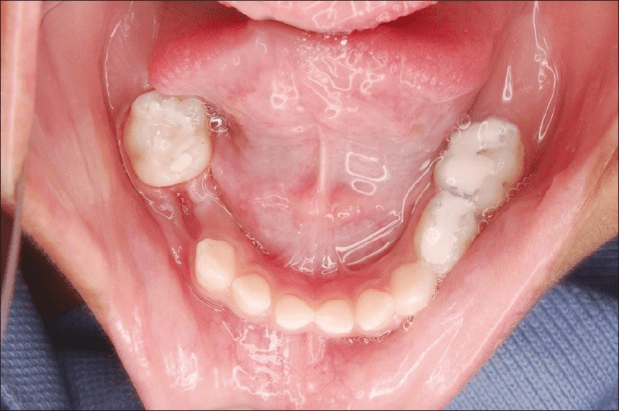 علت افتادن زود هنگام دندان شیری چیست؟