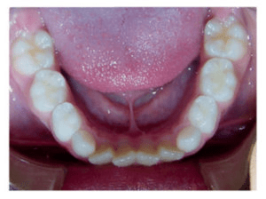 علت کج درآمدن و بهم ریختگی در دندان های دائمی جلویی فک پایین