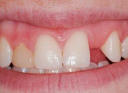 علل درنیامدن دندان دائمی چیست؟