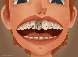همه چیز درباره‌ی پوسیدگی دندان در کودکان